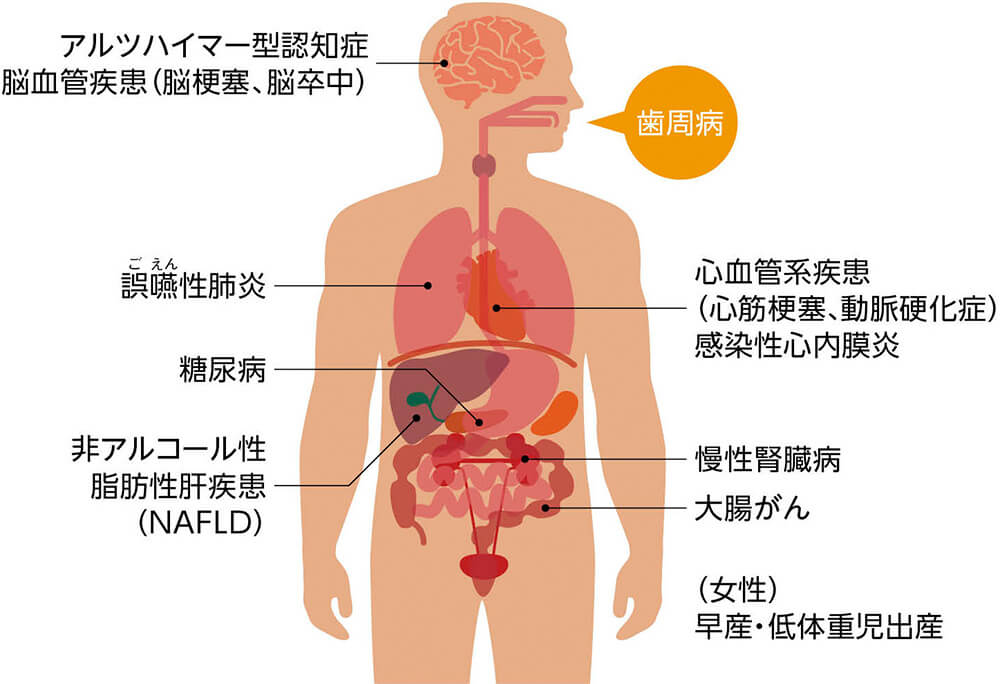 アルツハイマー型認知症 脳血管疾患(脳梗塞、脳卒中) 誤嚥性肺炎 心血管系疾患(心筋梗塞、動脈硬化症) 感染性心内膜炎 糖尿病 非アルコール性脂肪肝炎(NAFLD) 慢性腎臓病 大腸がん (女性)早産・低体重児出産