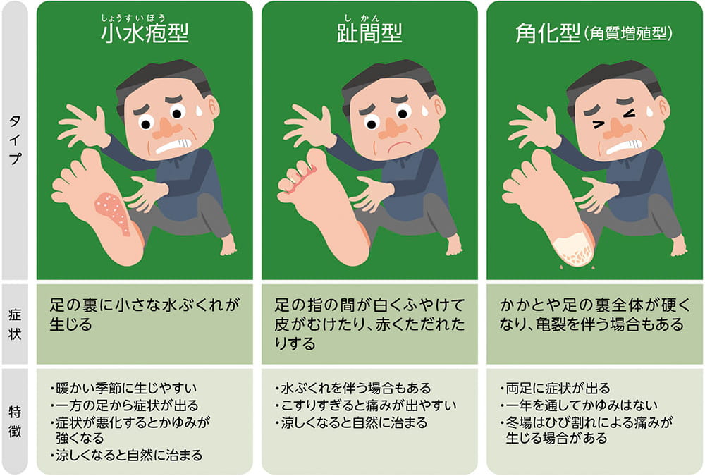 タイプ:小水疱型(しょうすいほうがた) 症状:足の裏に小さな水ぶくれが生じる。特徴:暖かい季節に生じやすい。一方の足から症状が出る。症状が悪化するとかゆみが強くなる。涼しくなると自然に治まる。 タイプ:趾間型(しかんがた) 症状:足の指の間が白くふやけて皮がむけたり、赤くただれたりする。特徴:水ぶくれを伴う場合もある。こすりすぎると痛みが出やすい。涼しくなると自然に治まる。 タイプ:角化型(角質増殖型) 症状:かかとや足の裏全体が硬くなり、亀裂を伴う場合もある。特徴:両足に症状が出る。一年を通してかゆみはない。冬場は足のひび割れによる痛みが生じる場合がある。