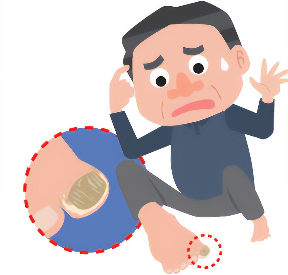 足の親指の爪が変色している状態のイラスト
